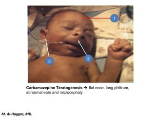 Carbamazepine Teratogenesis  flat nose, long philtrum,
abnormal ears and microcephaly
1
2
3
M. Al-Haggar, MD.
 