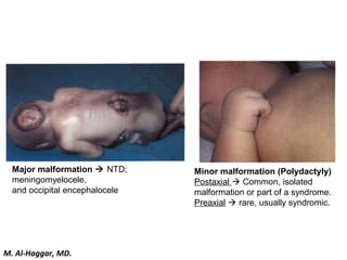 Major malformation  NTD;
meningomyelocele,
and occipital encephalocele
Minor malformation (Polydactyly)
Postaxial  Common, isolated
malformation or part of a syndrome.
Preaxial  rare, usually syndromic.
M. Al-Haggar, MD.
 