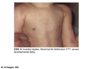 CDG  Inverted nipples, Abnormal fat distribution, FTT, severe
developmental delay.
M. Al-Haggar, MD.
 