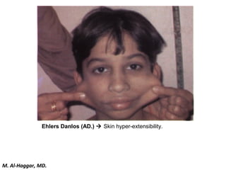 Ehlers Danlos (AD.)  Skin hyper-extensibility.
M. Al-Haggar, MD.
 