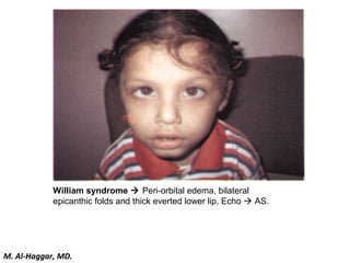 William syndrome  Peri-orbital edema, bilateral
epicanthic folds and thick everted lower lip, Echo  AS.
M. Al-Haggar, MD.
 