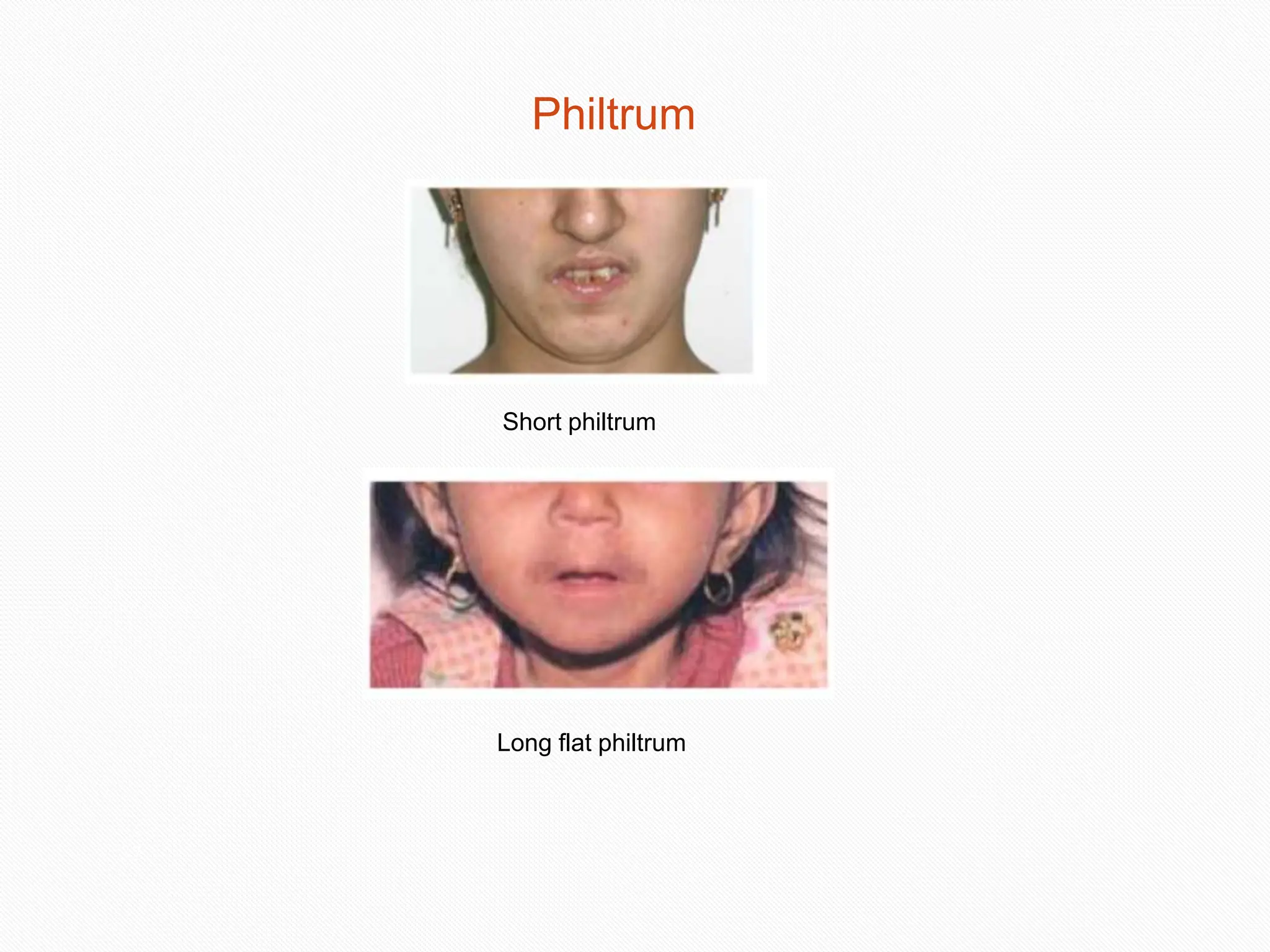 Philtrum
Short philtrum
Long flat philtrum
37
 