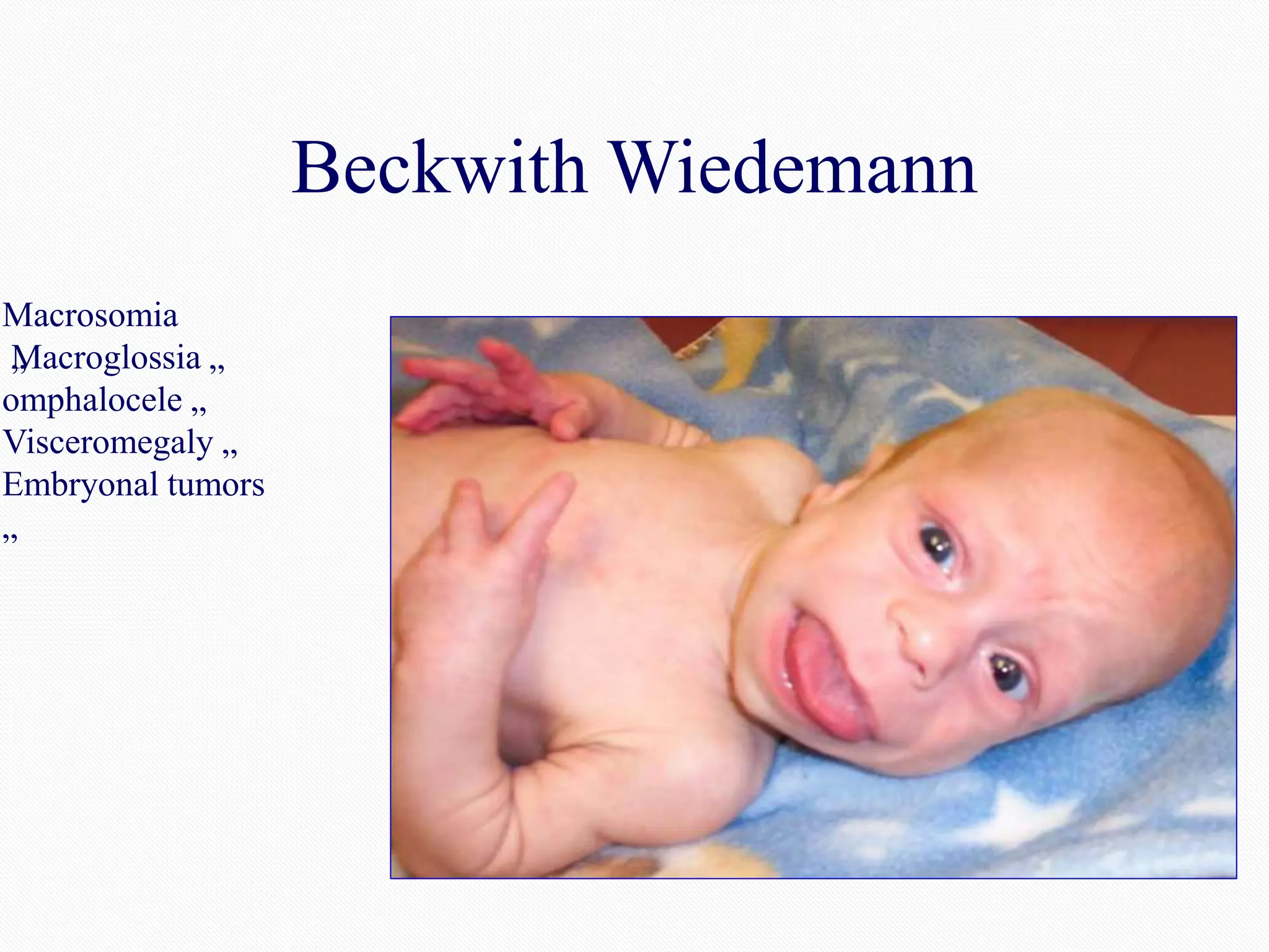 Beckwith Wiedemann
Macrosomia
„
Macroglossia „
omphalocele „
Visceromegaly „
Embryonal tumors
„
 