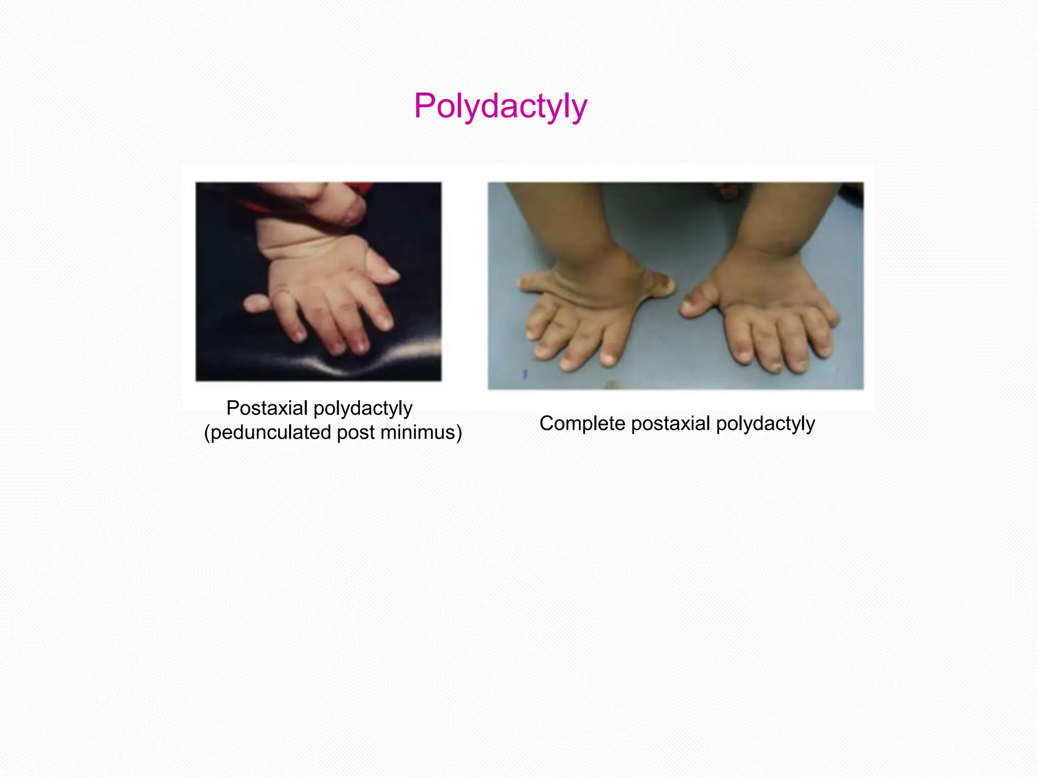 Polydactyly
Postaxial polydactyly
(pedunculated post minimus) Complete postaxial polydactyly
42
 