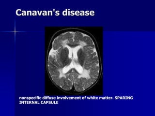 Dysmyelination syndromes | PDF