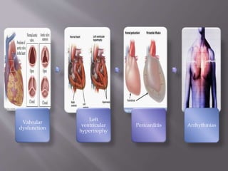 Valvular
dysfunction
Left
ventricular
hypertrophy
Pericarditis Arrhythmias
 