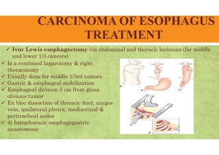 CARCINOMA OF ESOPHAGUS
TREATMENT
 Ivor Lewis esophagectomy via abdominal and thoracic incisions (for middle
and lower 1/3 cancers)
 Is a combined laparotomy & right
thoracotomy
 Usually done for middle 1/3rd tumors
 Gastric & esophageal mobilization
 Esophageal division 5 cm from gross
obvious tumor
 En bloc dissection of thoracic duct, azygos
vein, ipsilateral pleura, mediastinal &
peritracheal nodes
 4) Intrathoracic esophagogastric
anastomosis
 