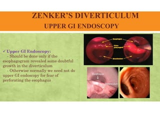ZENKER’S DIVERTICULUM
UPPER GI ENDOSCOPY
 Upper GI Endoscopy:
- Should be done only if the
esophagogram revealed some doubtful
growth in the diverticulum
- Otherwise normally we need not do
upper GI endoscopy for fear of
perforating the esophagus
 