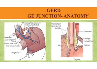 GERD
GE JUNCTION- ANATOMY
 