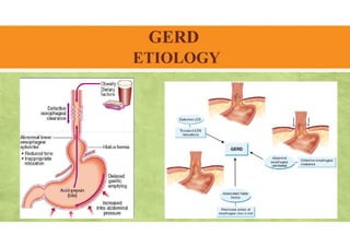 GERD
ETIOLOGY
 