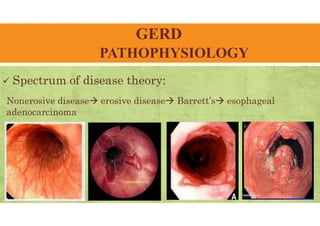 GERD
PATHOPHYSIOLOGY
 Spectrum of disease theory:
Nonerosive disease erosive disease Barrett’s esophageal
adenocarcinoma
 