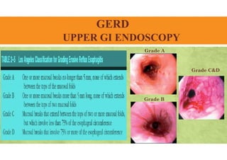 GERD
UPPER GI ENDOSCOPY
Grade A
Grade B
Grade C&D
 