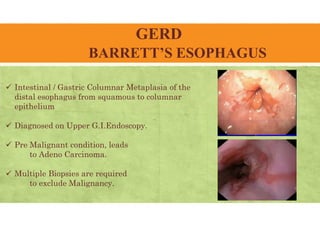GERD
BARRETT’S ESOPHAGUS
 Intestinal / Gastric Columnar Metaplasia of the
distal esophagus from squamous to columnar
epithelium
 Diagnosed on Upper G.I.Endoscopy.
 Pre Malignant condition, leads
to Adeno Carcinoma.
 Multiple Biopsies are required
to exclude Malignancy.
 