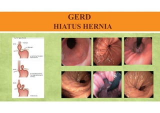 GERD
HIATUS HERNIA
 