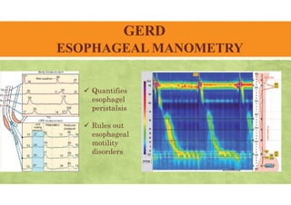 GERD
ESOPHAGEAL MANOMETRY
 Quantifies
esophagel
peristalsis
 Rules out
esophageal
motility
disorders
 