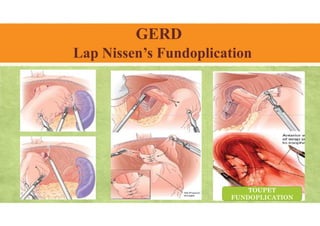 GERD
Lap Nissen’s Fundoplication
TOUPET
FUNDOPLICATION
 