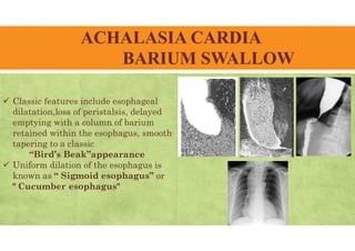 ACHALASIA CARDIA
BARIUM SWALLOW
 Classic features include esophageal
dilatation,loss of peristalsis, delayed
emptying with a column of barium
retained within the esophagus, smooth
tapering to a classic
“Bird’s Beak”appearance
 Uniform dilation of the esophagus is
known as “ Sigmoid esophagus” or
" Cucumber esophagus"
 