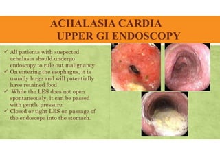 ACHALASIA CARDIA
UPPER GI ENDOSCOPY
 All patients with suspected
achalasia should undergo
endoscopy to rule out malignancy
 On entering the esophagus, it is
usually large and will potentially
have retained food
 While the LES does not open
spontaneously, it can be passed
with gentle pressure.
 Closed or tight LES on passage of
the endoscope into the stomach.
 