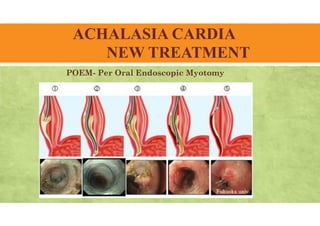 ACHALASIA CARDIA
NEW TREATMENT
POEM- Per Oral Endoscopic Myotomy
 