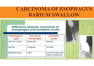 CARCINOMA OF ESOPHAGUS
BARIUM SWALLOW
 