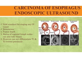 CARCINOMA OF ESOPHAGUS
ENDOSCOPIC ULTRASOUND
 Gold standard for staging any GI
tumor
 Determines
1. Tumor depth
2. Status of regional lymph nodes-
can also take biopsy
3. However can not differentiate T1 &
T2 lesions preciously
 