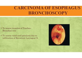 CARCINOMA OF ESOPHAGUS
BRONCHOSCOPY
 To assess invasion of Tracheo-
Bronchial tree
 To assess vocal cord paralysis due to
infiltration of Recurrent Laryngeal N.
 