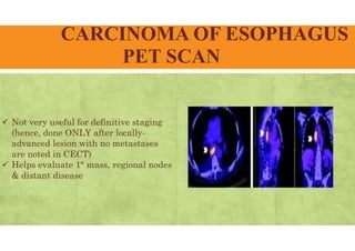 CARCINOMA OF ESOPHAGUS
PET SCAN
 Not very useful for definitive staging
(hence, done ONLY after locally-
advanced lesion with no metastases
are noted in CECT)
 Helps evaluate 1° mass, regional nodes
& distant disease
 