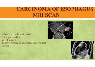 CARCINOMA OF ESOPHAGUS
MRI SCAN
 Not routinely performed
 Helps identify
a) T4 lesions
b) involvement of vascular, liver, neural
tissues
 