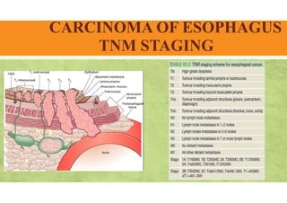 CARCINOMA OF ESOPHAGUS
TNM STAGING
 