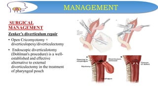 MANAGEMENT
SURGICAL
MANAGEMENT
Zenker’s diverticulum repair
• Open Cricomyotomy +
diverticulopexy/diverticulectomy
• Endoscopic diverticulotomy
(Dohlman's procedure) is a well-
established and effective
alternative to external
diverticulectomy in the treatment
of pharyngeal pouch
 
