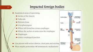 Impacted foreign bodies
 Anatomical areas of narrowing:
 Arches of the faucets
 Vallecula
 Piriform fossa
 Cricopharyngeus
 Where left bronchus crosses esophagus
 Where the arches of aorta cross the esophagus
 Diaphragm
 Gastro-esophageal junction
 Can present with severe distress, chest pain and retching.
 There maybe perforation  hematemesis, mediastinitis
17
 
