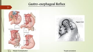 Gastro-esophageal Reflux
Toupet procedureNissen fundoplication
31
 