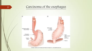 Carcinoma of the esophagus37
 
