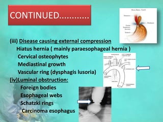 CONTINUED............
(iii) Disease causing external compression
Hiatus hernia ( mainly paraesophageal hernia )
Cervical osteophytes
Mediastinal growth
Vascular ring (dysphagis lusoria)
(iv)Luminal obstruction:
Foreign bodies
Esophageal webs
Schatzki rings
Carcinoma esophagus
 