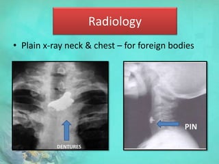 Radiology
• Plain x-ray neck & chest – for foreign bodies
DENTURES
PIN
 