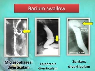 Barium swallow
Mid esophageal
diverticulam
Epiphrenic
diverticulam
Zenkers
diverticulam
 