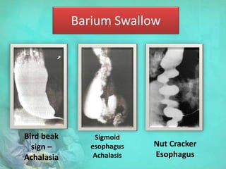 Barium Swallow
Bird beak
sign –
Achalasia
Sigmoid
esophagus
Achalasis
Nut Cracker
Esophagus
 