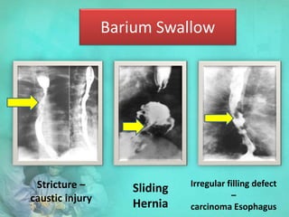 Barium Swallow
Stricture –
caustic injury
Sliding
Hernia
Irregular filling defect
–
carcinoma Esophagus
 