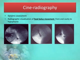 Cine-radiography
• Dynamic assessment
• Radiographic visualisation of food bolus movement from oral cavity to
hypophyrnx
 