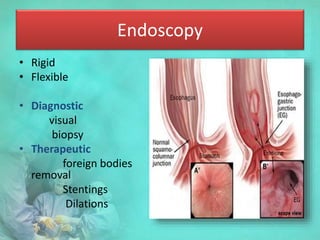 Endoscopy
• Rigid
• Flexible
• Diagnostic
visual
biopsy
• Therapeutic
foreign bodies
removal
Stentings
Dilations
 