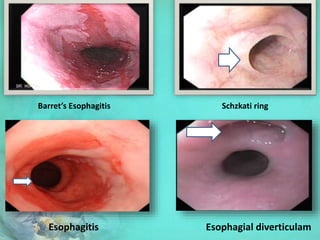 Barret’s Esophagitis Schzkati ring
Esophagitis Esophagial diverticulam
 
