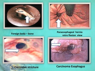 Corrosive stricture Carcinoma Esophagus
Foreign body – bone
Paraesophageal hernia
retro flexion view
 