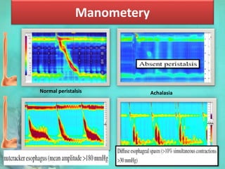 Manometery
Normal peristalsis Achalasia
Nutcracker esophagus Diffuse esophageal spasm
 