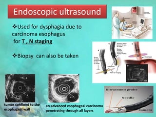 Endoscopic ultrasound
tumor confined to the
esophageal wall
an advanced esophageal carcinoma
penetrating through all layers
Used for dysphagia due to
carcinoma esophagus
for T , N staging
Biopsy can also be taken
 
