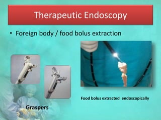 Therapeutic Endoscopy
• Foreign body / food bolus extraction
Graspers
Food bolus extracted endoscopically
 