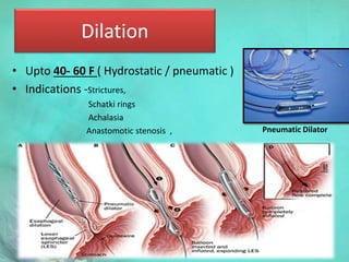 Dilation
• Upto 40- 60 F ( Hydrostatic / pneumatic )
• Indications -Strictures,
Schatki rings
Achalasia
Anastomotic stenosis , Pneumatic Dilator
 