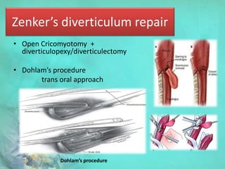 Zenker’s diverticulum repair
• Open Cricomyotomy +
diverticulopexy/diverticulectomy
• Dohlam’s procedure
trans oral approach
Dohlam’s procedure
 