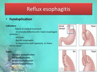 Reflux esophagitis
• Fundoplication
indications
failure of medical treatment
structurally defective LES ( lower esophageal
spintcher )
stricture
Barrets esophagitis
in conjunction with myotomy or hiatus
hernia repair
Types :
Nissen’s fundoplication
Dor fundoplication
Toupet fundoplication
Besely fundoplication
 