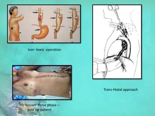 Ivor- lewis operation
Trans-Hiatal approach
Mc Keown three phase –
post op patient
 