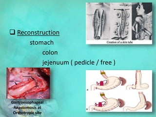  Reconstruction
stomach
colon
jejenuum ( pedicle / free )
Gastroesophageal
Anastomosis at
Orthotropic site
 